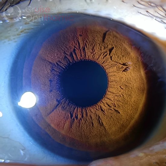 

Optometrial DWY-25 Адаптер увеличения для офтальмологических снимков